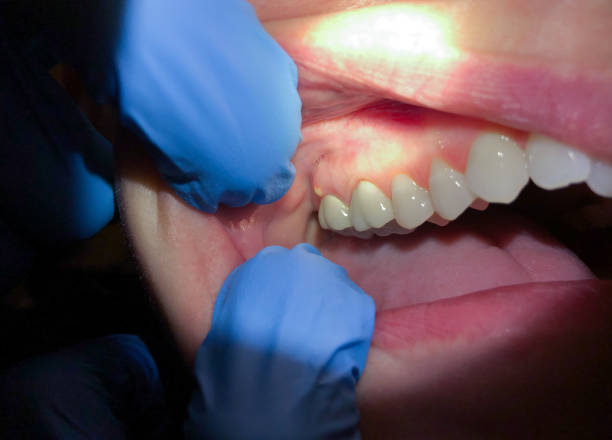 Best Broken or Cracked Tooth Emergency Dentist in Allendale, NJ